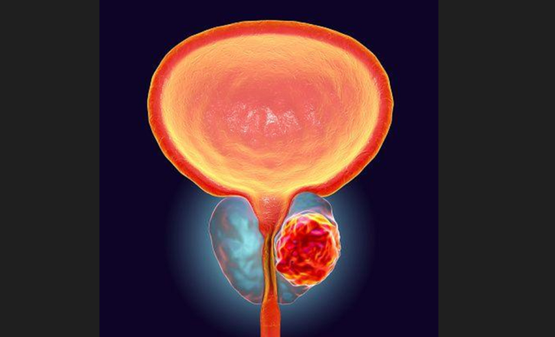 बढ्दो प्रोस्टेट क्यान्सर : के हो लक्षण, कसरी गर्ने उपचार ?